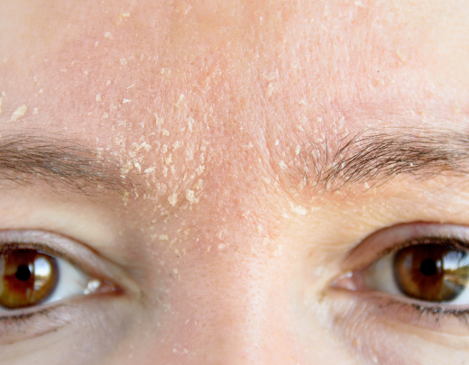 Ako sa starať o suchú pleť v zime? Kompletný návod na hydratovanú a zdravú pokožku.